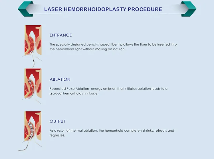 Dual Laser 980nm 1470nm Laser Surgery Equipment for Anal Stenosis Ablation Laser 980