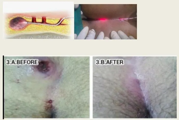 Top Sale German Tech Hospital Clinical Hemorrhoids Proctology Instruments Surgical 1470nm Laser